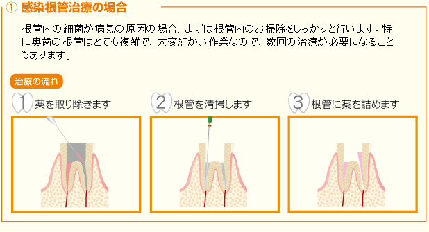 感染根管治療の場合