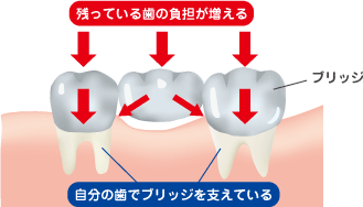 自分の歯でブリッジを支えている