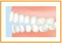 開咬イメージ